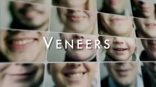 Veneers
