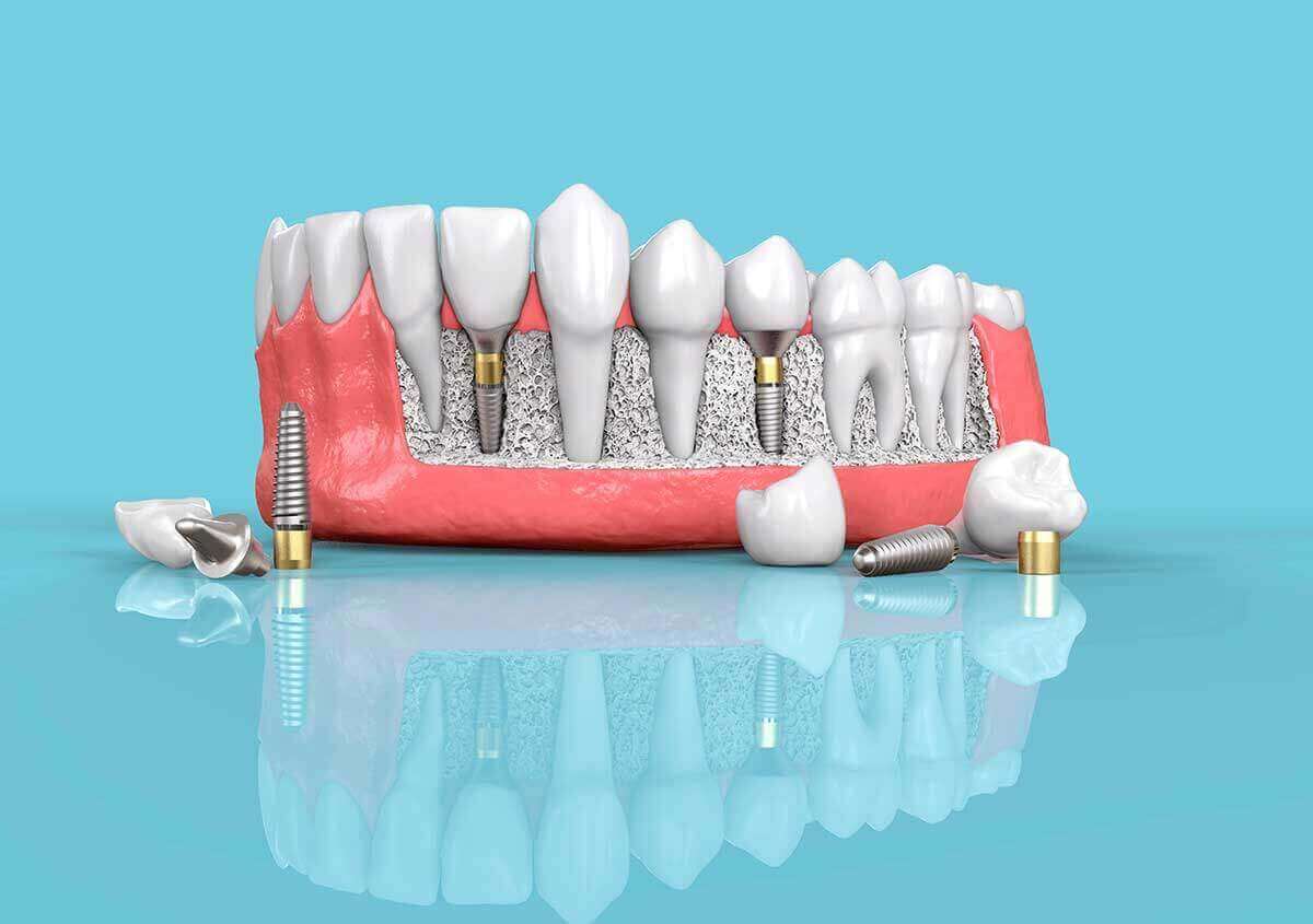 Dental Implants in Fairlawn OH Area