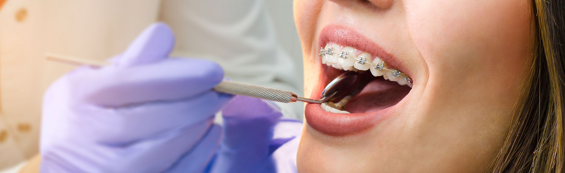 A child smiling with conventional braces, showing effective orthodontic treatment for alignment.