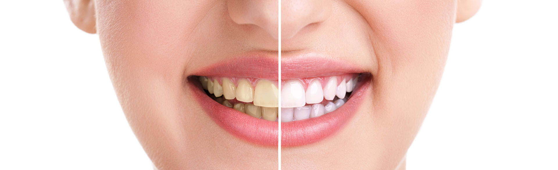 Teeth whitening before-and-after results showcasing visibly brighter and whiter teeth.