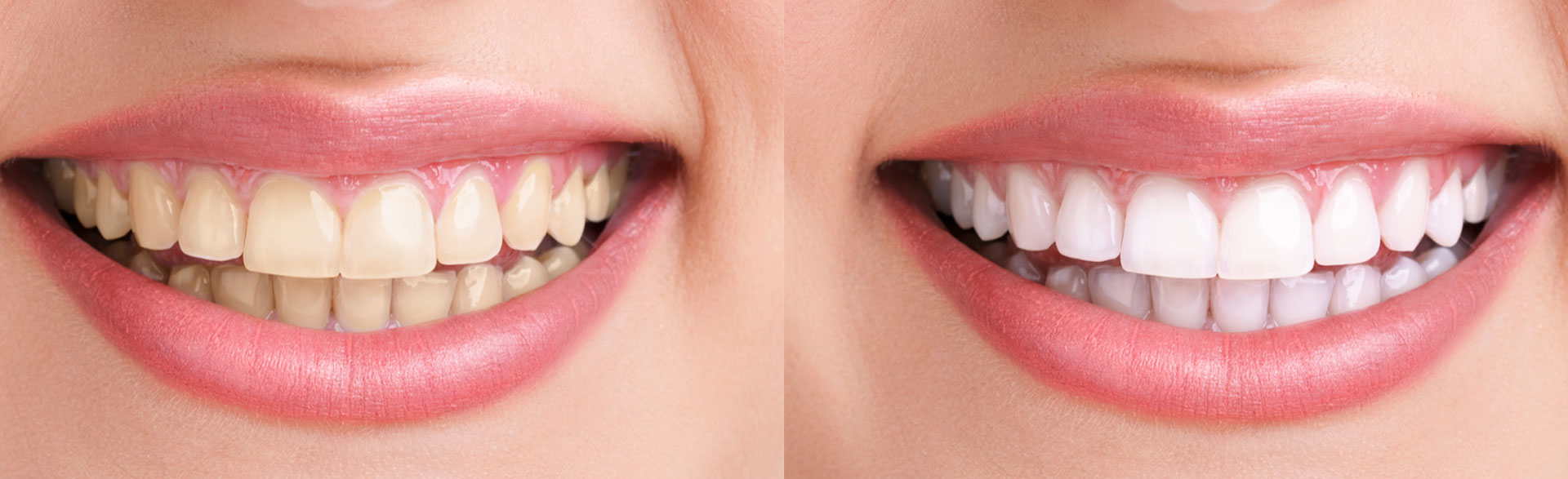 Veneers before-and-after comparison, highlighting a transformed and flawless smile.
