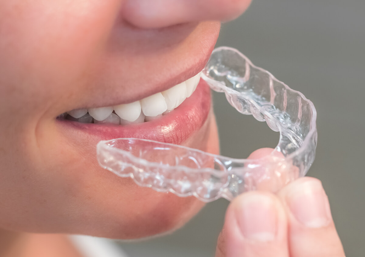Clear Teeth Aligners in Fairlawn OH Area