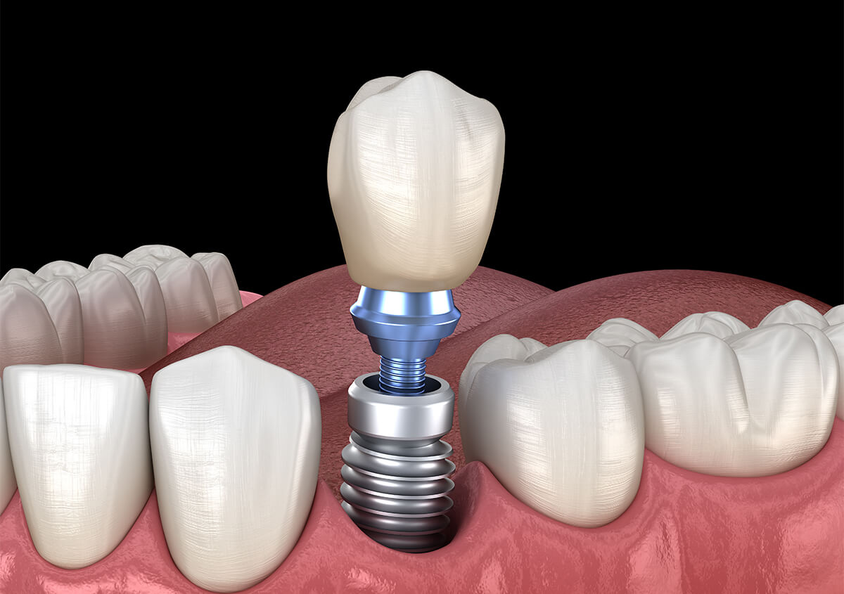 Dental Implants Care in Fairlawn OH Area
