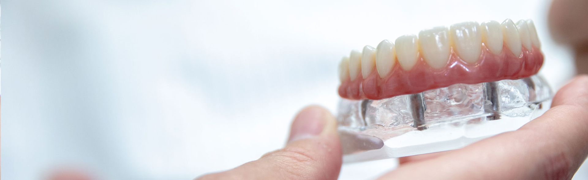 Full-mouth dentures displayed on a model, illustrating comprehensive tooth replacement.