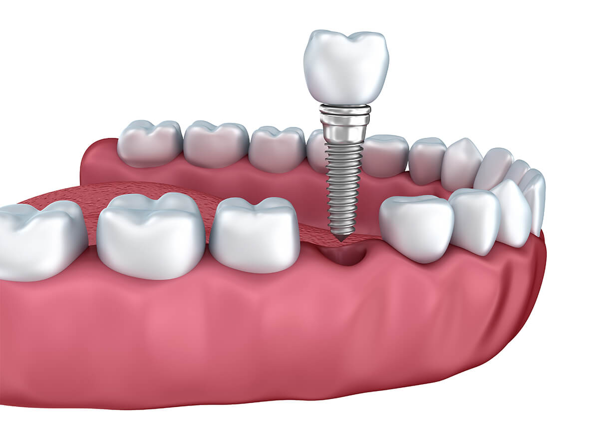 Dental Implants Near Me Fairlawn OH Area