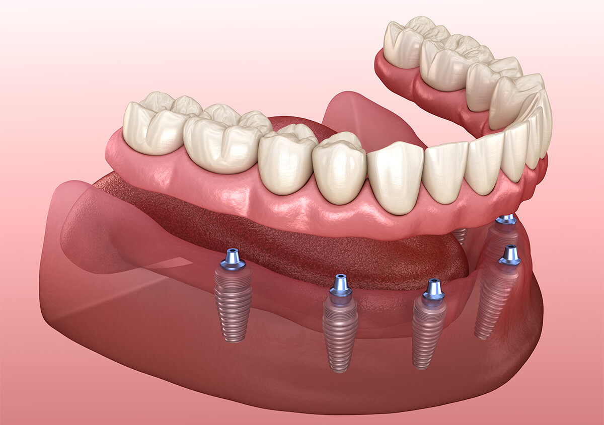 Full Mouth Dental Implants in Fairlawn Area