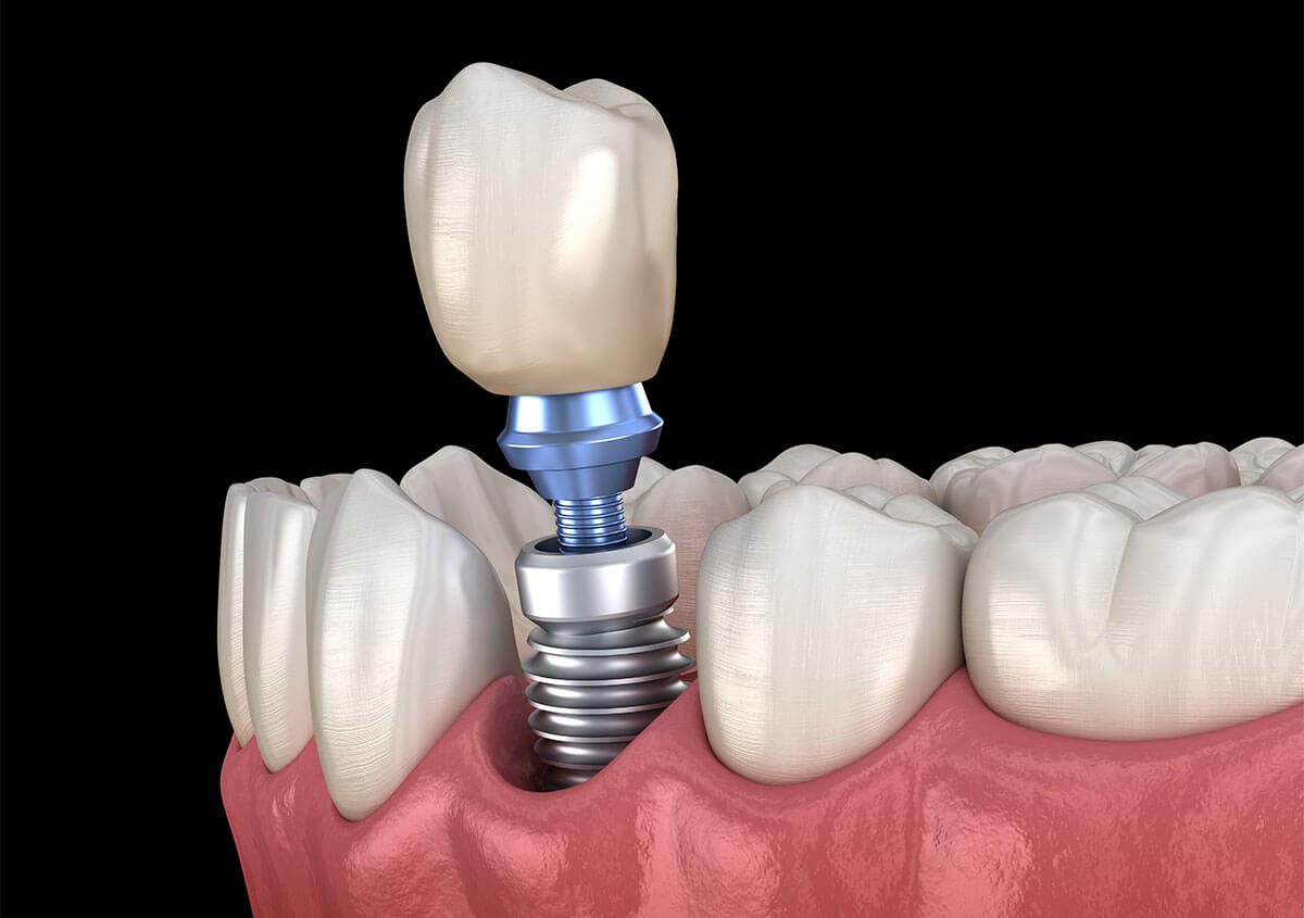 Replace Teeth With Implants in Fairlawn OH Area