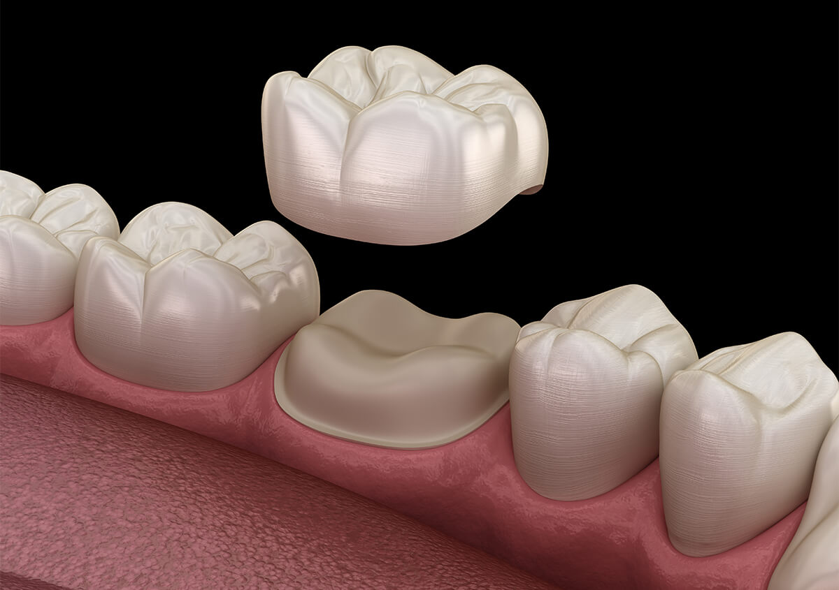 CEREC Same Day Porcelain Crowns in Fairlawn OH Area