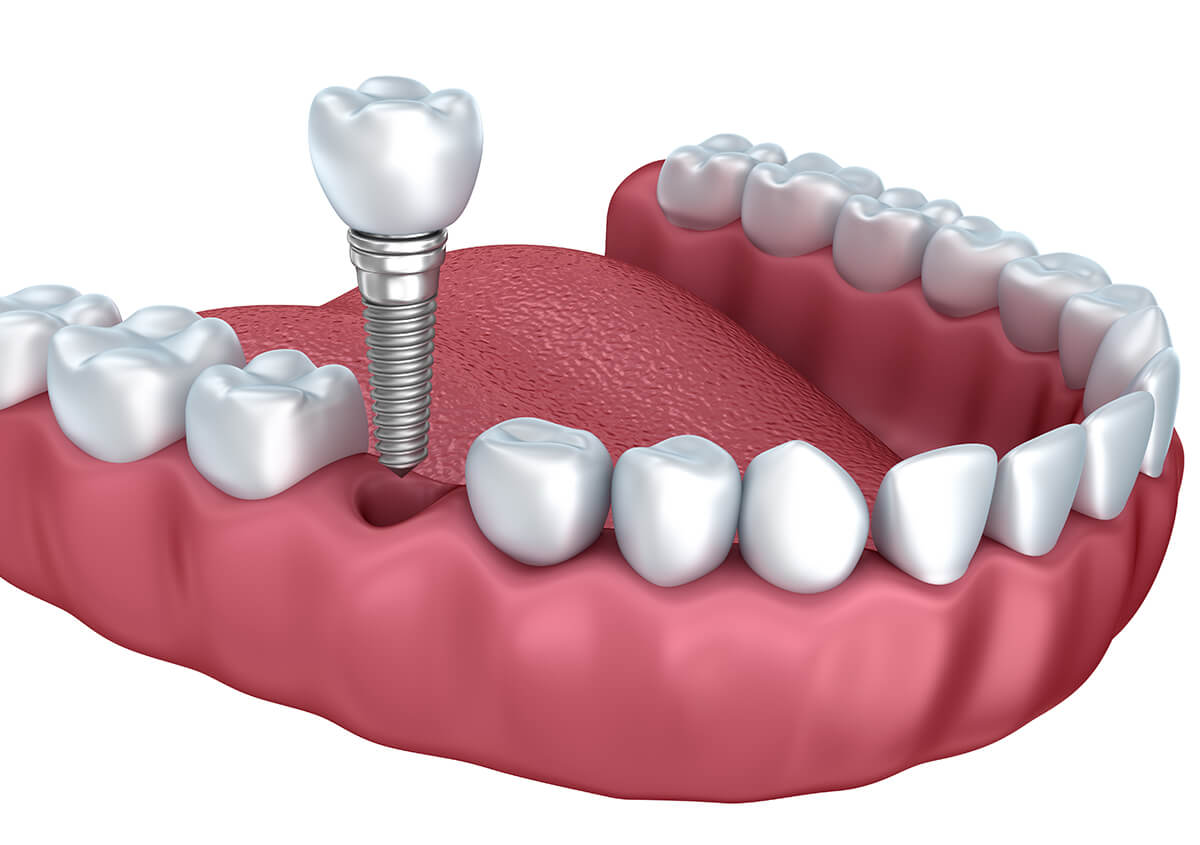 Dentist for Implants Near Me Fairlawn OH Area