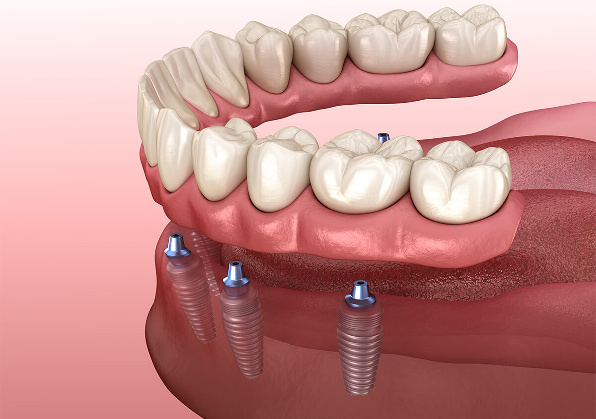 Dental Implants for Missing Teeth in Fairlawn OH Area
