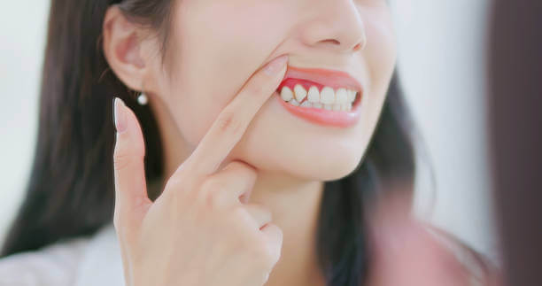 an image showing a woman showing her gums