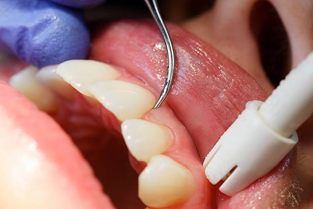 an image showing a teeth of a person during dental exam