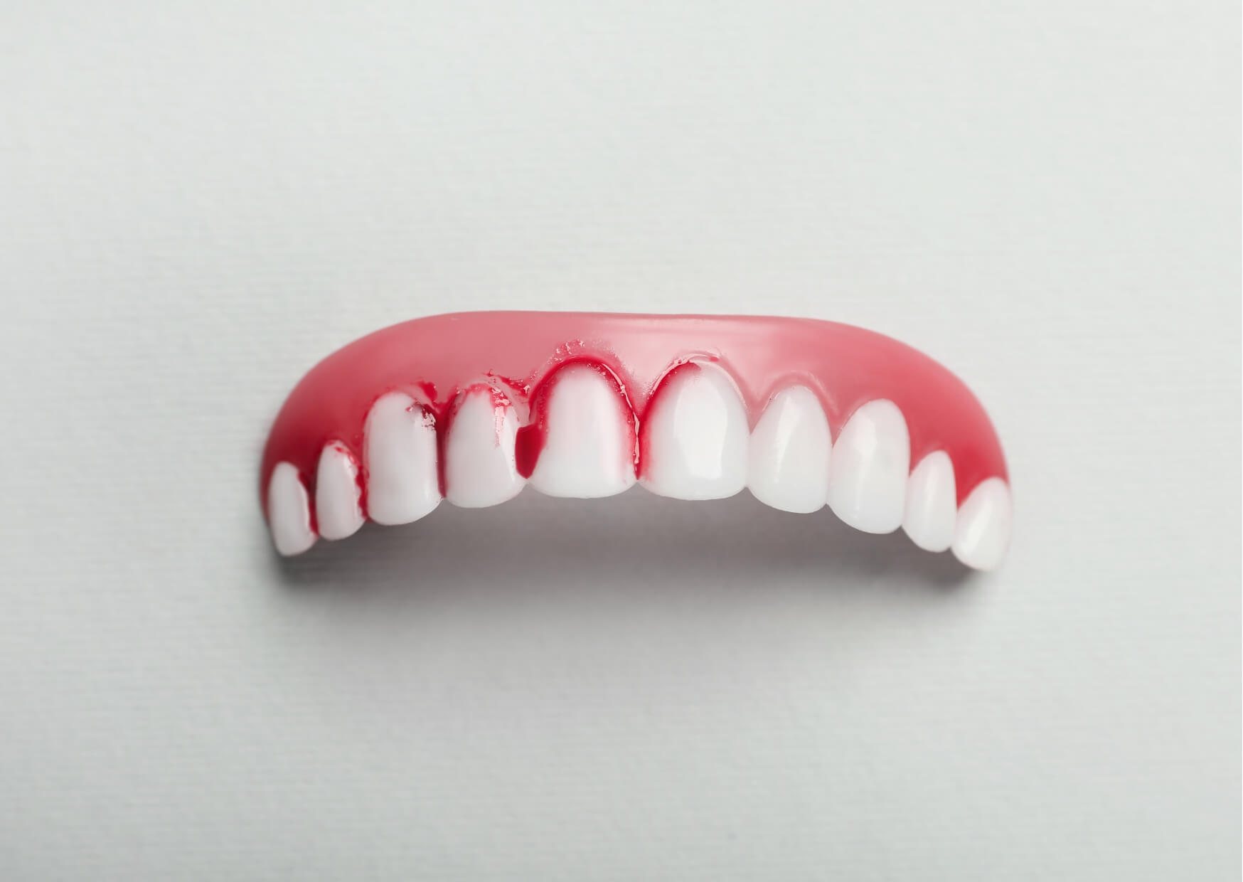 Dental model showing red, inflamed gums around the teeth, illustrating common gingivitis symptoms such as gum redness, swelling, and bleeding.