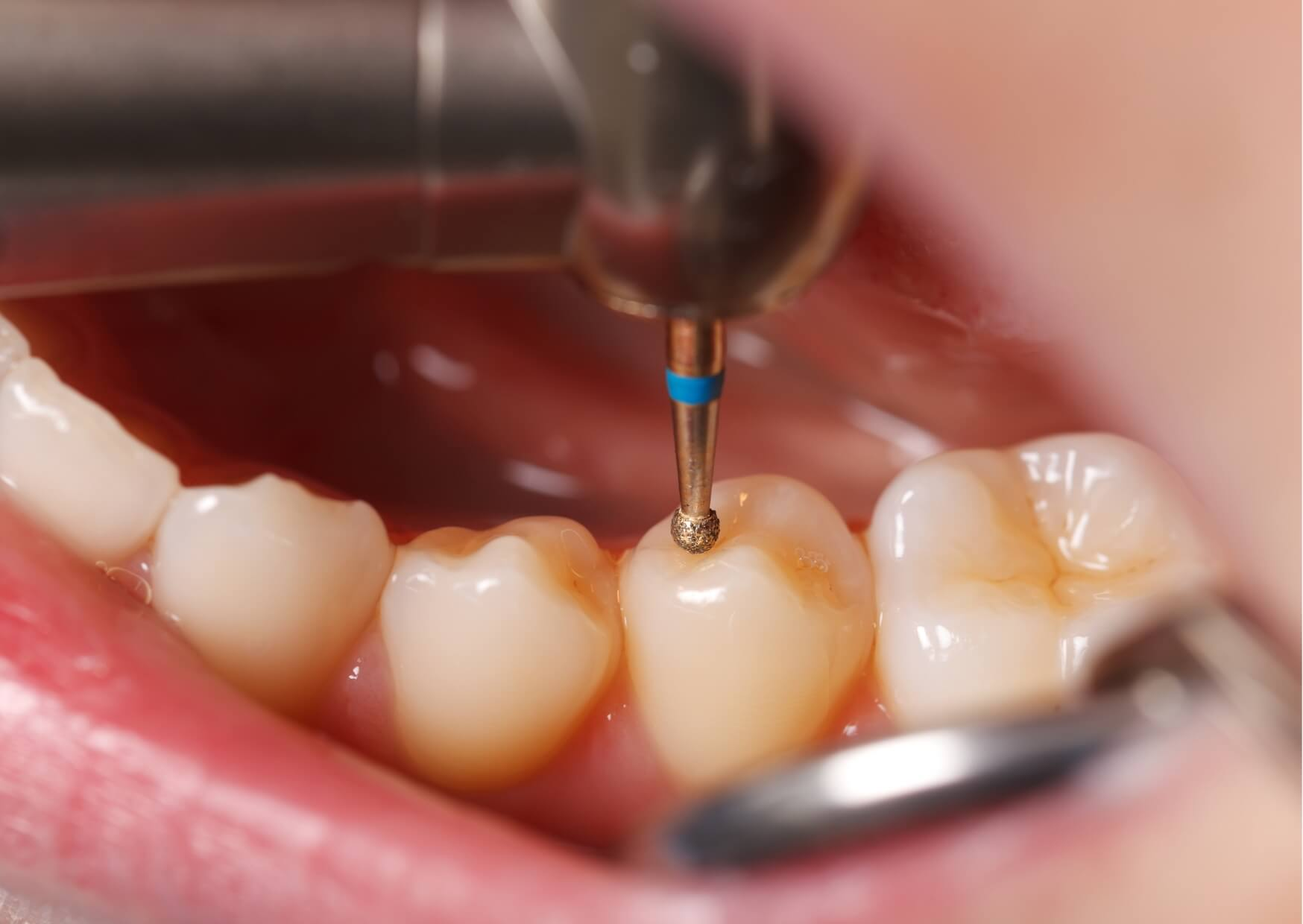 Close-up of a dentist preparing a tooth for a dental filling during a procedure that typically takes less than an hour.