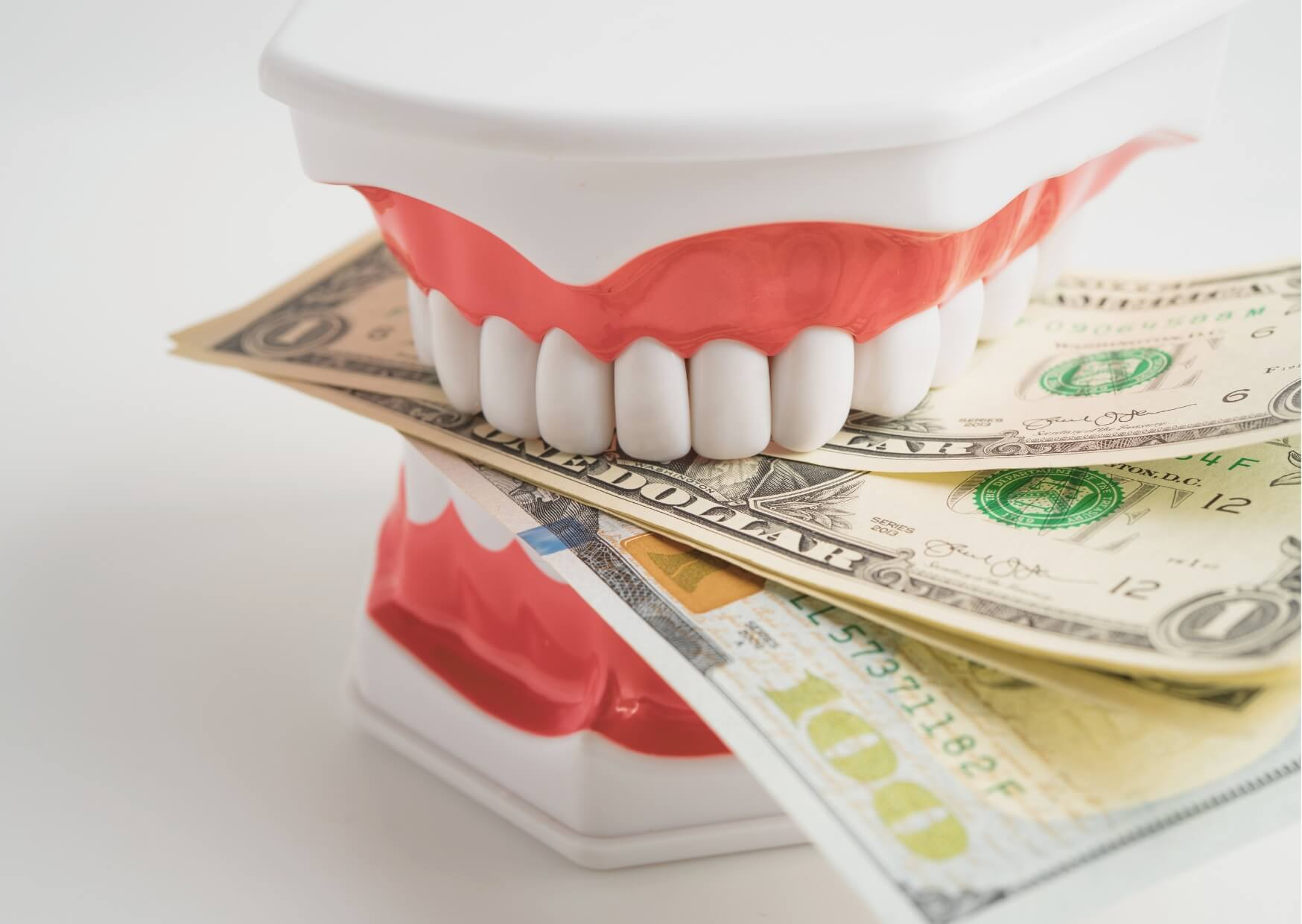 Dental model placed on U.S. dollar bills illustrating the cost of dental bonding and factors that affect treatment pricing.