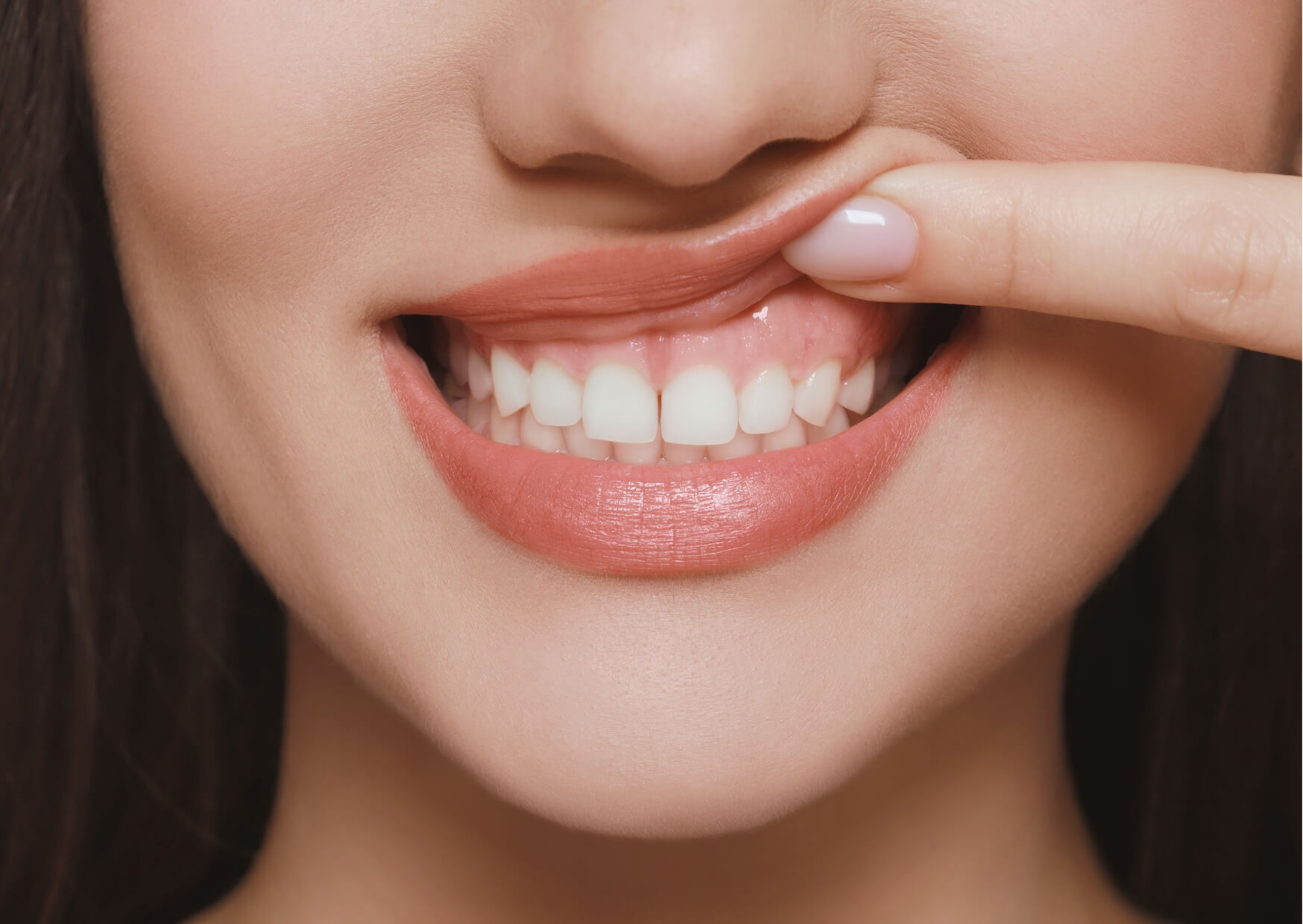 Close-up of a smile with the upper lip lifted to show the gumline before gummy smile treatment and gum contouring evaluation.