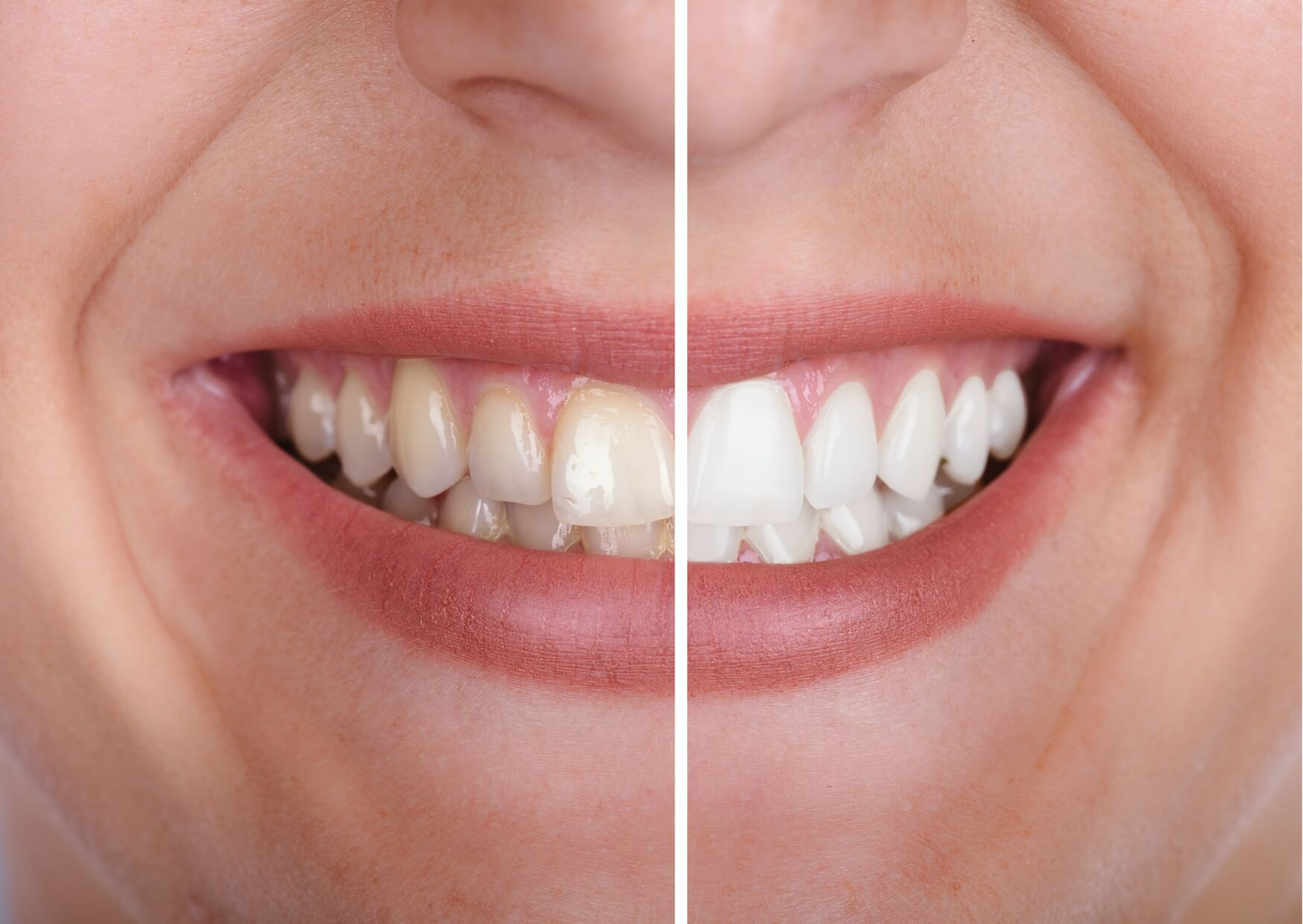Before and after smile makeover comparison showing stained teeth transformed into a brighter, whiter, and more even smile.