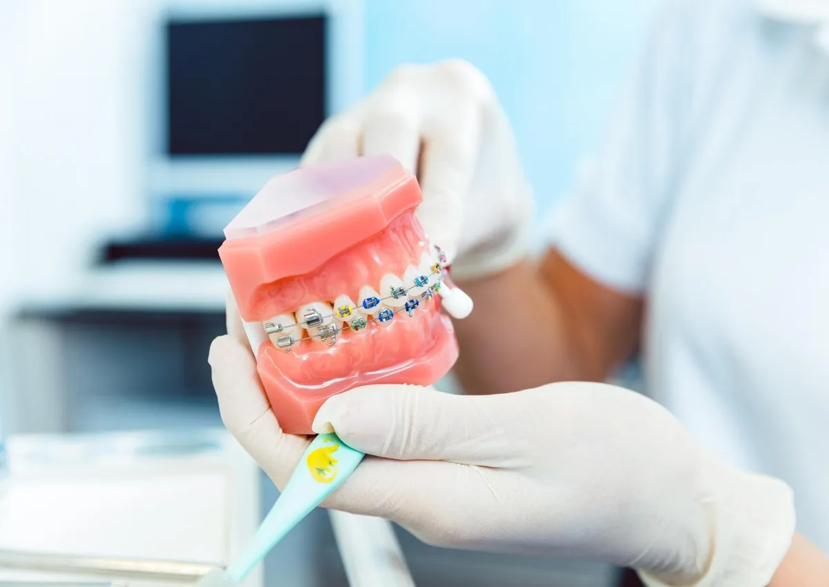 Dental model with traditional metal braces used to explain braces cost and orthodontic treatment options.
