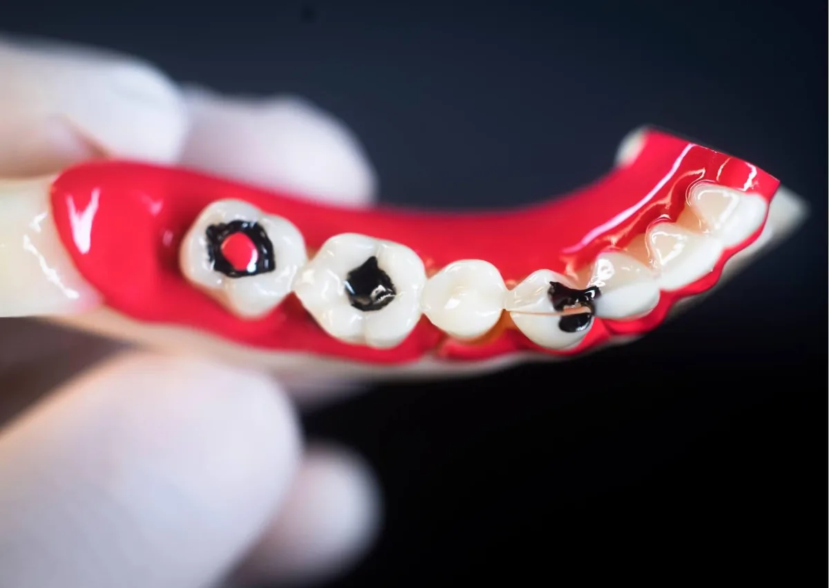 Dental model showing dark areas of tooth decay to illustrate what cavities can look like on teeth.