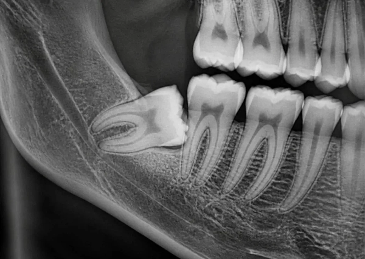 Dental X-ray showing an impacted wisdom tooth coming in sideways beneath the gums.